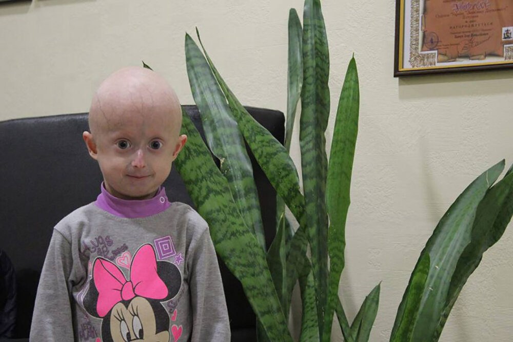 10-річна Ірина Химич з синдромом передчасного старіння померла ...